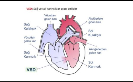 Doğuştan kalp hastalığı VSD: Belirtileri, riskleri ve tedavi süreci